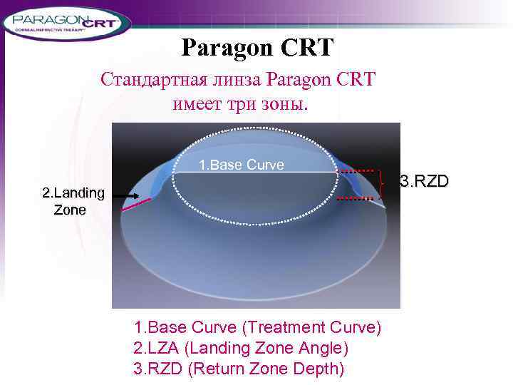 Paragon CRT Стандартная линза Paragon CRT имеет три зоны. 1. Base Curve 2. Landing