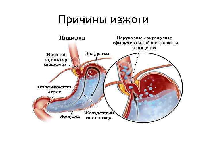 Почему часто бывает. Причины возникновения изжоги. Факторы возникновения изжоги.