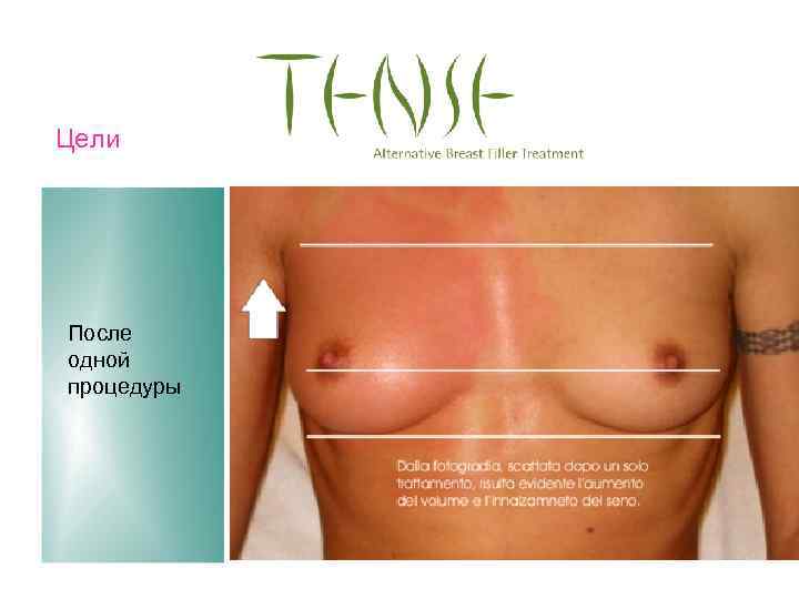 Цели После одной процедуры 