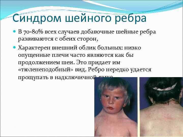 Синдром шейного ребра В 70 -80% всех случаев добавочные шейные ребра развиваются с обеих