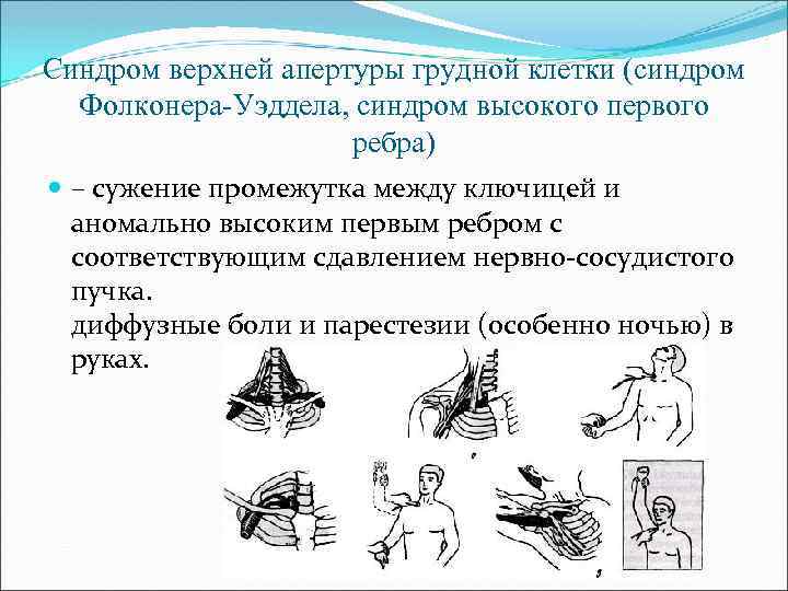 Синдром верхней апертуры грудной клетки (синдром Фолконера-Уэддела, синдром высокого первого ребра) – сужение промежутка