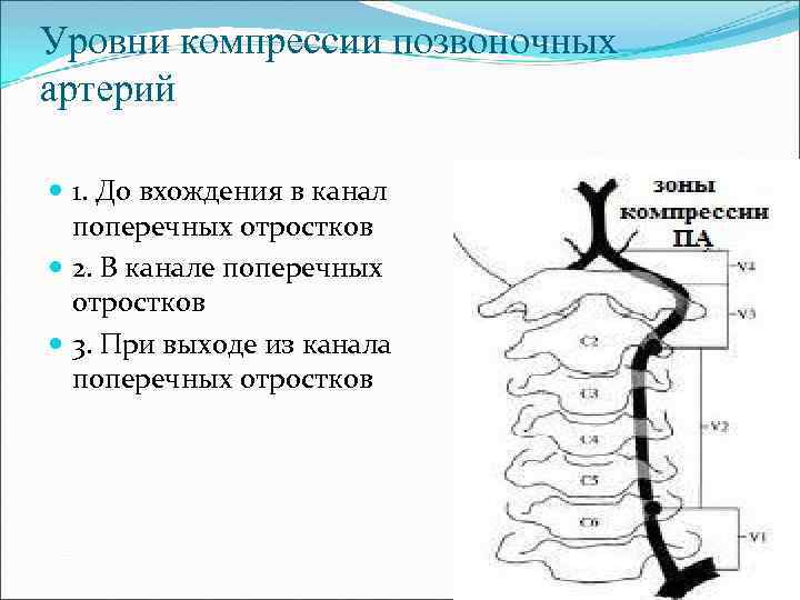 Уровни компрессии позвоночных артерий 1. До вхождения в канал поперечных отростков 2. В канале