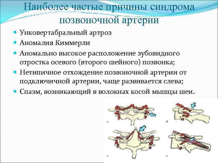 Наиболее частые причины синдрома позвоночной артерии Унковертабральный артроз Аномалия Киммерли Аномально высокое расположение зубовидного