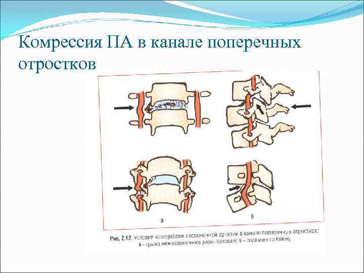 Комрессия ПА в канале поперечных отростков 