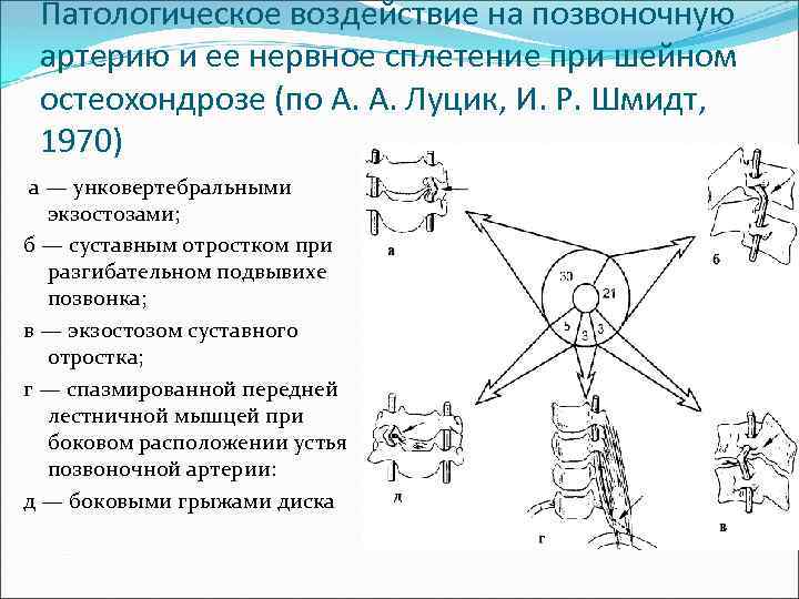 Патологическое воздействие на позвоночную артерию и ее нервное сплетение при шейном остеохондрозе (по А.