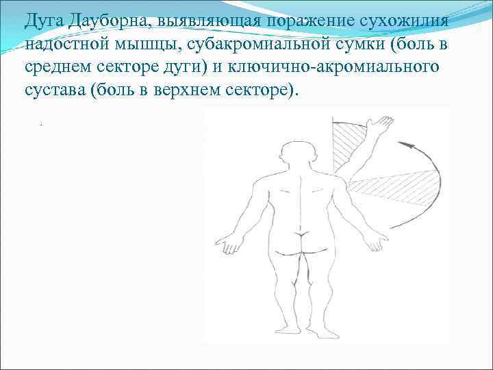 Дуга Дауборна, выявляющая поражение сухожилия надостной мышцы, субакромиальной сумки (боль в среднем секторе дуги)