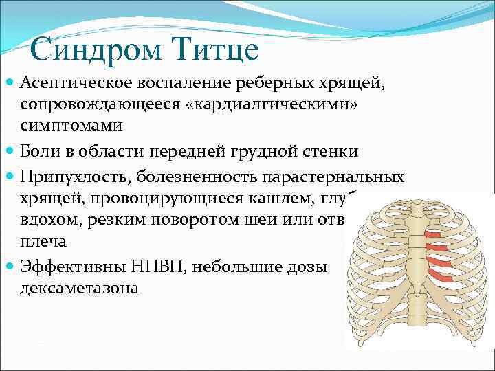 Синдром Титце Асептическое воспаление реберных хрящей, сопровождающееся «кардиалгическими» симптомами Боли в области передней грудной
