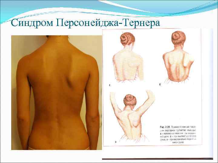 Синдром Персонейджа-Тернера 