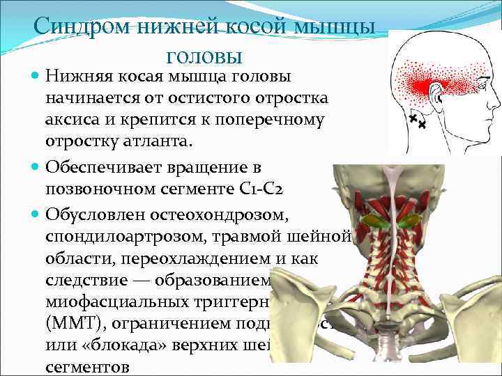 Синдром нижней косой мышцы головы Нижняя косая мышца головы начинается от остистого отростка аксиса