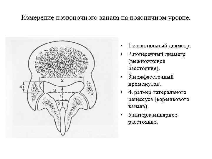 Измерение позвоночного канала на поясничном уровне. • 1. сагиттальный диаметр. • 2. поперечный диаметр