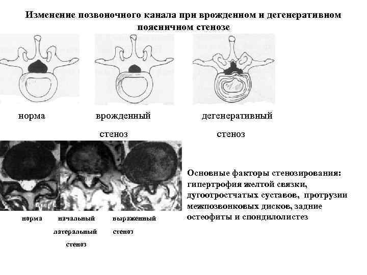 Изменение позвоночного канала при врожденном и дегенеративном поясничном стенозе норма врожденный дегенеративный стеноз норма