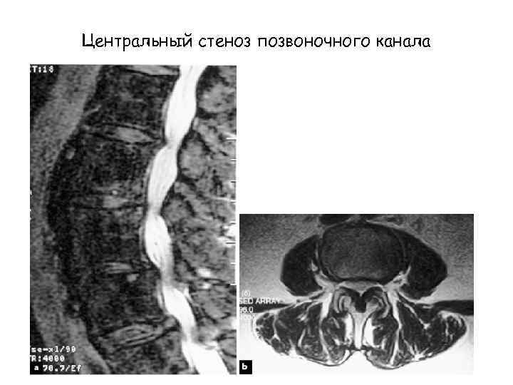 Клиническая картина компрессии корешков конского хвоста отличается от компрессии конуса и эпиконуса