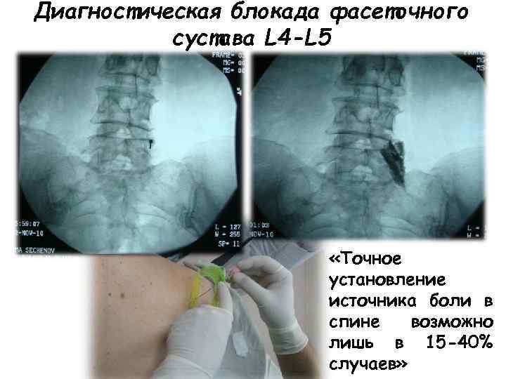 Диагностическая блокада фасеточного сустава L 4 -L 5 «Точное установление источника боли в спине