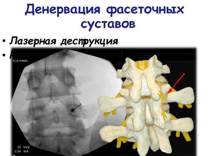 Фасеточные суставы. Радиочастотная деструкция фасеточных суставов. Денервация фасеточных суставов позвоночника. Артроз фасеточных суставов. Лазерная денервация фасеточных суставов.