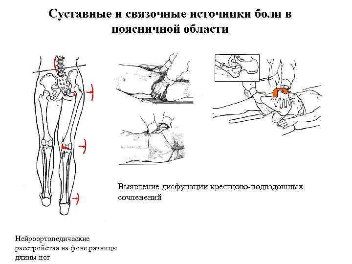 Суставные и связочные источники боли в поясничной области Выявление дисфункции крестцово-подвздошных сочленений Нейроортопедические расстройства