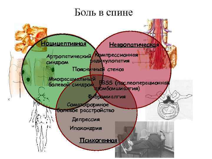 Боль в спине Ноцицептивная Невропатическая Артропатический Компрессионная радикулопатия синдром Поясничный стеноз Миофасциальный болевой синдром