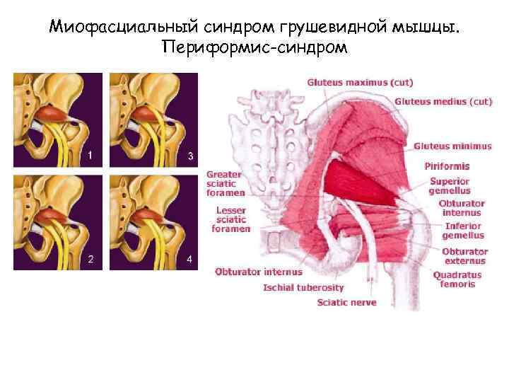 Миофасциальный синдром грушевидной мышцы. Периформис-синдром 