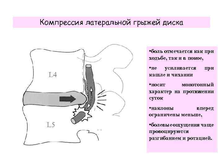 Компрессия латеральной грыжей диска • боль отмечается как при ходьбе, так и в покое,