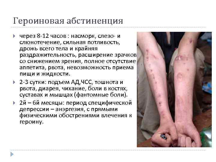 Героиновая абстиненция через 8 -12 часов : насморк, слезо- и слюнотечение, сильная потливость, дрожь