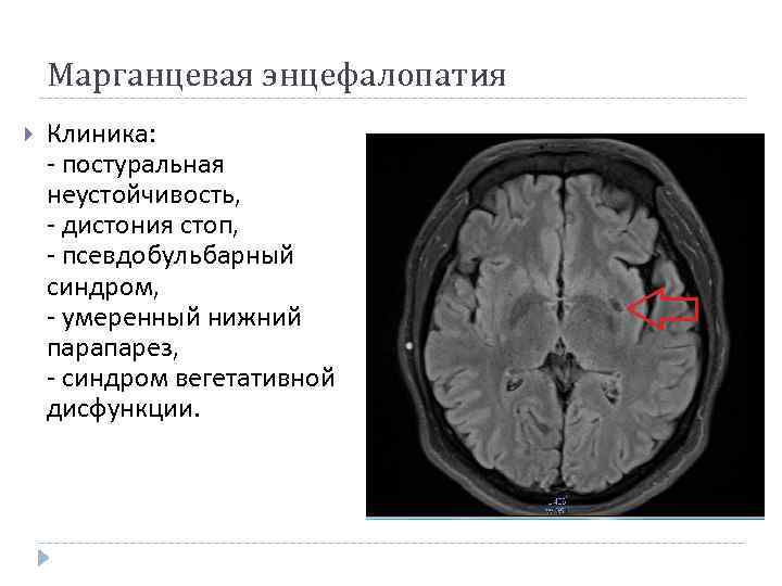 Марганцевая энцефалопатия Клиника: - постуральная неустойчивость, - дистония стоп, - псевдобульбарный синдром, - умеренный