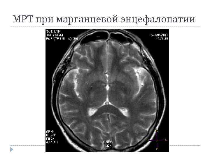 МРТ при марганцевой энцефалопатии 