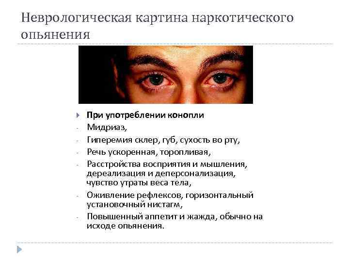 Неврологическая картина наркотического опьянения - - При употреблении конопли Мидриаз, Гиперемия склер, губ, сухость