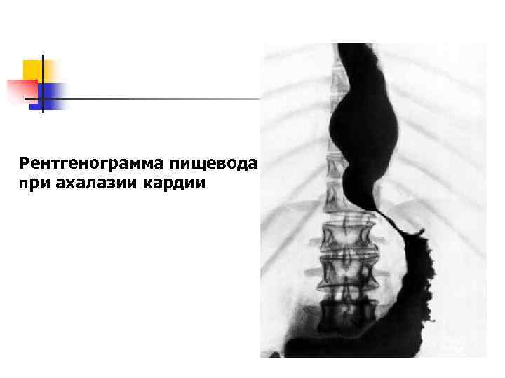 Рентгенограмма пищевода при ахалазии кардии 