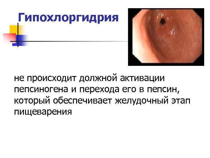 Гипохлоргидрия не происходит должной активации пепсиногена и перехода его в пепсин, который обеспечивает желудочный