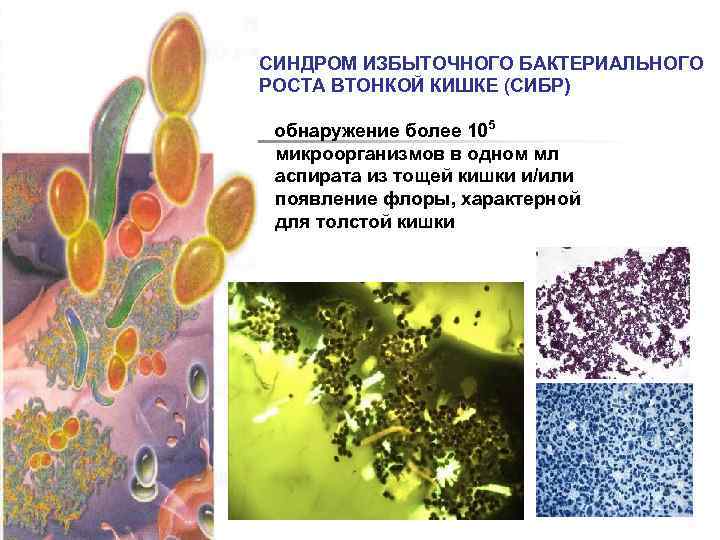 Сибр что это. Синдром избыточного бактериального роста. СИБР синдром избыточного бактериального роста в кишечнике. Синдром микробной контаминации. СИБР.