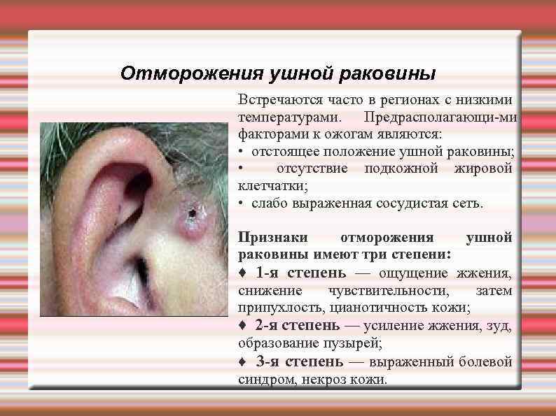 Отморожения ушной раковины Встречаются часто в регионах с низкими температурами. Предрасполагающи ми факторами к