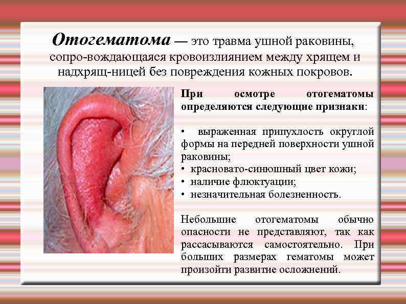 Отогематома — это травма ушной раковины, сопро вождающаяся кровоизлиянием между хрящем и надхрящ ницей