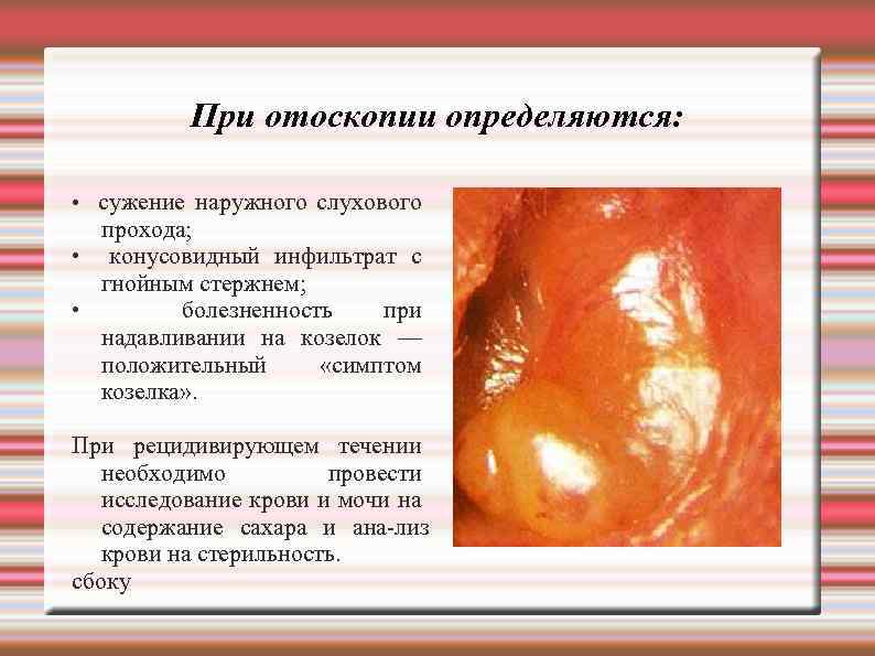 При отоскопии определяются: • сужение наружного слухового прохода; • конусовидный инфильтрат с гнойным стержнем;