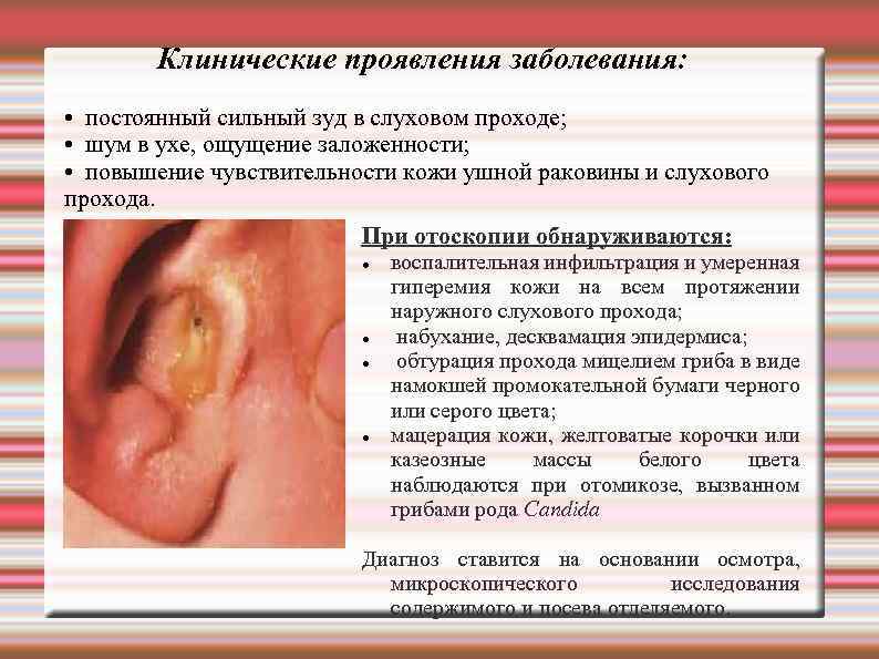 Клинические проявления заболевания: • постоянный сильный зуд в слуховом проходе; • шум в ухе,