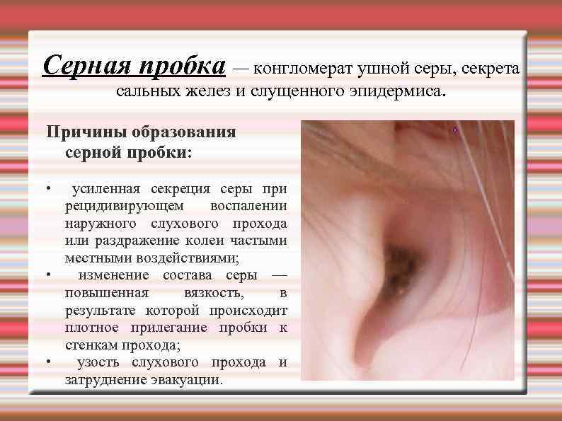 Серная пробка — конгломерат ушной серы, секрета сальных желез и слущенного эпидермиса. Причины образования