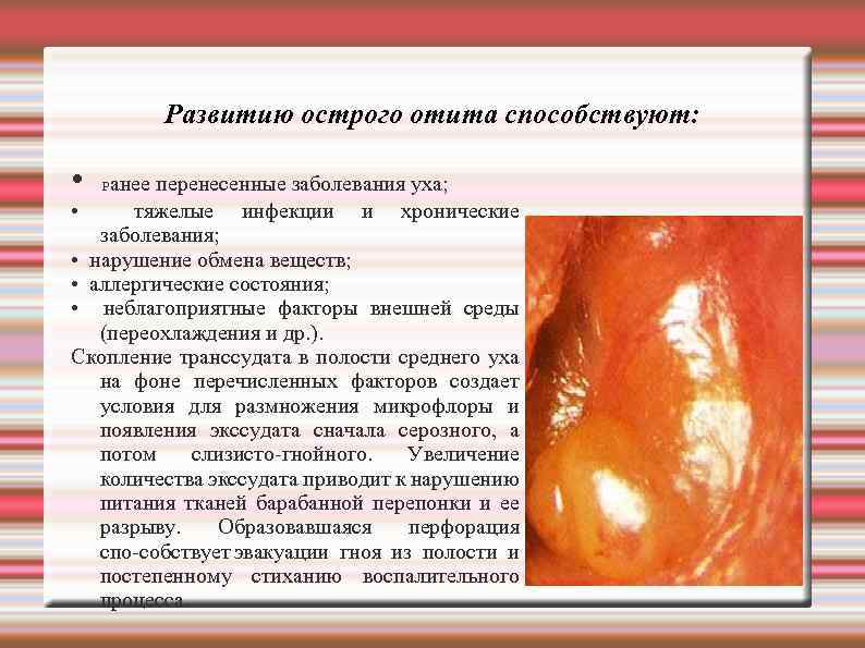 Развитию острого отита способствуют: • анее перенесенные заболевания уха; • тяжелые инфекции и хронические