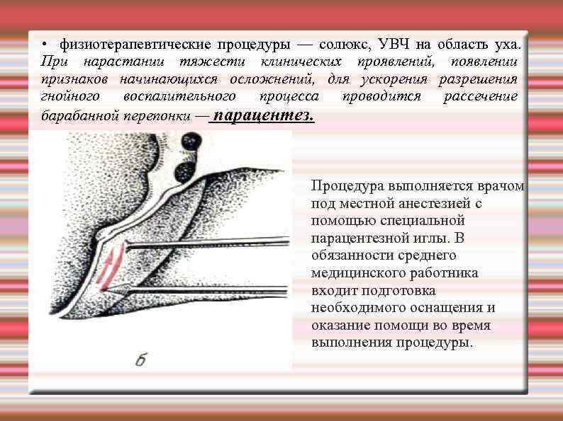  • физиотерапевтические процедуры — солюкс, УВЧ на область уха. При нарастании тяжести клинических