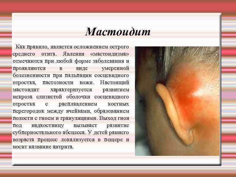 Мастоидит Как правило, является осложнением острого среднего отита. Явления «мастоидизма» отмечаются при любой форме