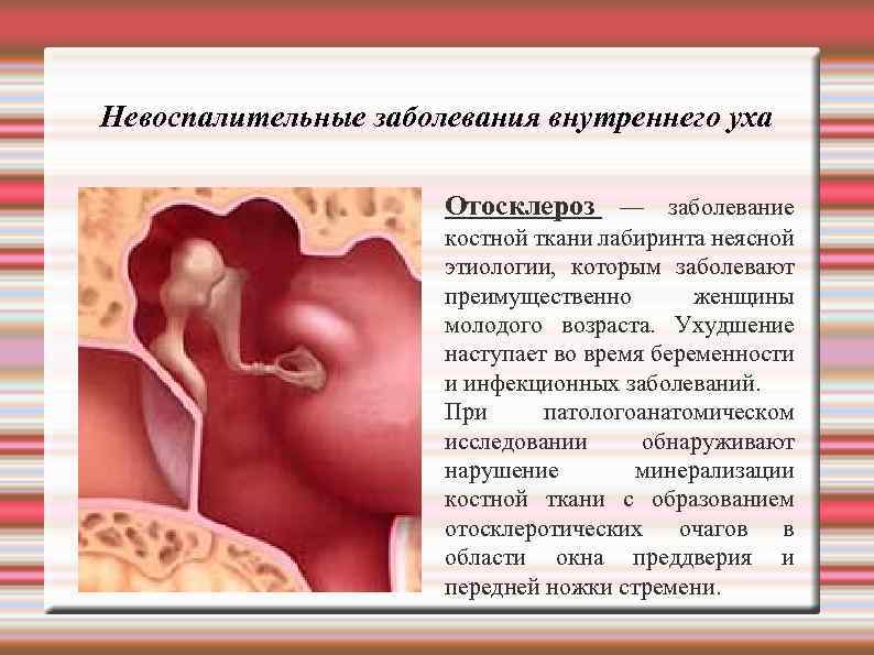 Невоспалительные заболевания внутреннего уха Отосклероз — заболевание костной ткани лабиринта неясной этиологии, которым заболевают