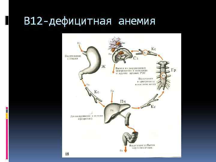 В 12 -дефицитная анемия 
