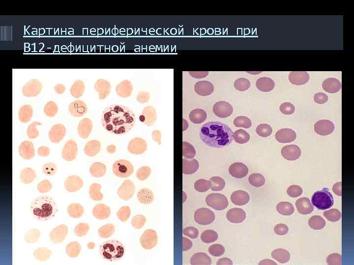 Картина периферической крови при В 12 -дефицитной анемии 