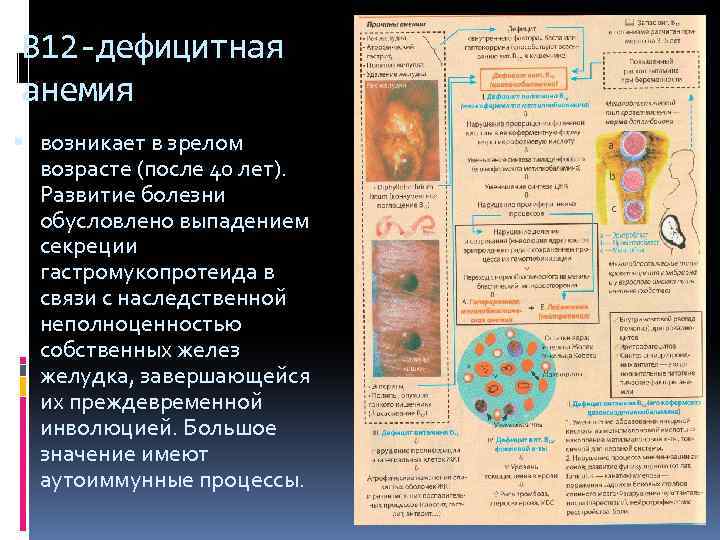 В 12 -дефицитная анемия возникает в зрелом возрасте (после 40 лет). Развитие болезни обусловлено