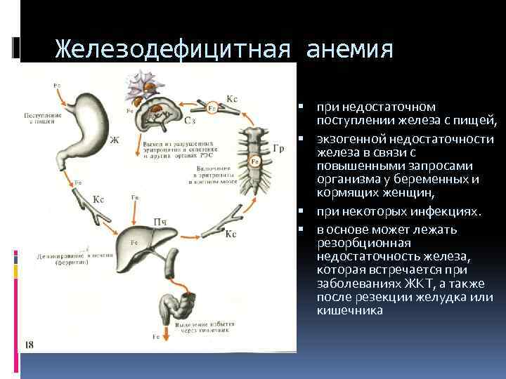 Железодефицитная анемия при недостаточном поступлении железа с пищей, экзогенной недостаточности железа в связи с