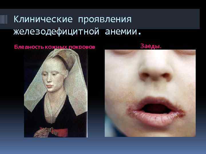 Клинические проявления железодефицитной анемии. Бледность кожных покровов Заеды. 