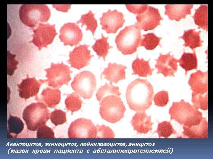 Акантоцитоз, эхиноцитоз, пойкилозоцитоз, аницитоз (мазок крови пациента с абеталипопротеинемией) 