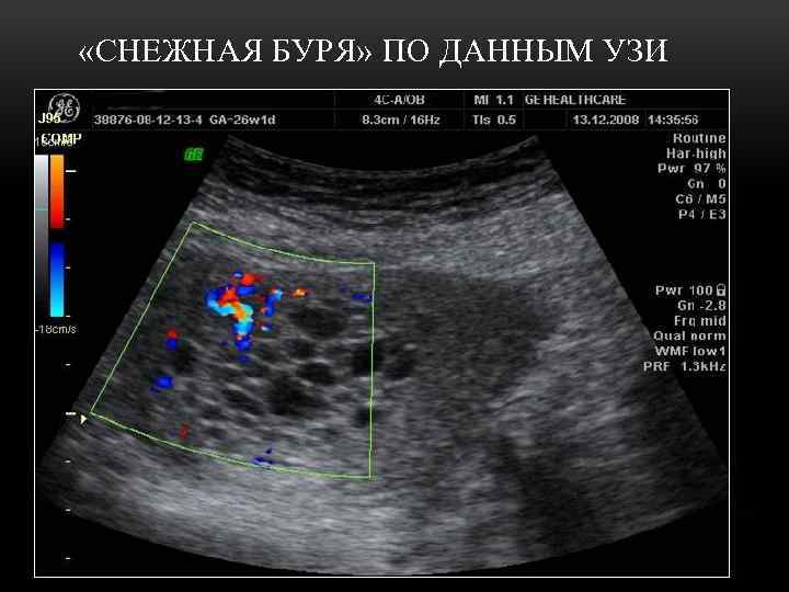  «СНЕЖНАЯ БУРЯ» ПО ДАННЫМ УЗИ 