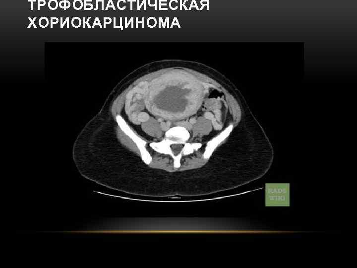 ТРОФОБЛАСТИЧЕСКАЯ ХОРИОКАРЦИНОМА 