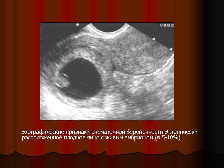Внематочная беременность симптомы признаки на раннем сроке
