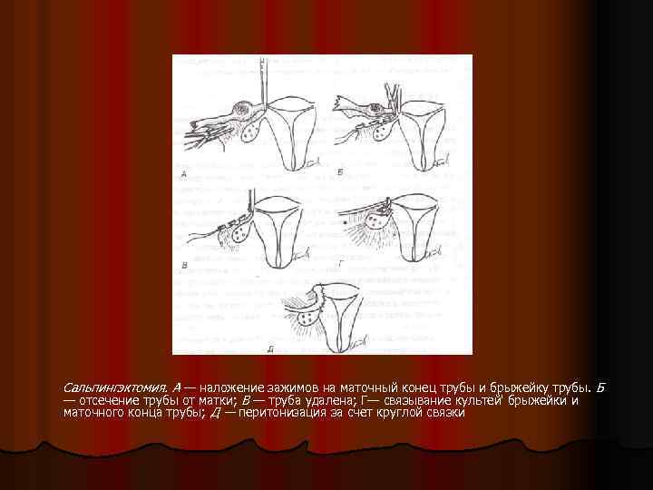 Сальпингэктомия. А — наложение зажимов на маточный конец трубы и брыжейку трубы. Б —