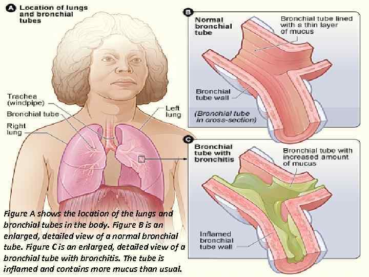 Figure A shows the location of the lungs and bronchial tubes in the body.