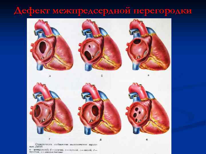 Дефект межпредсердной перегородки 